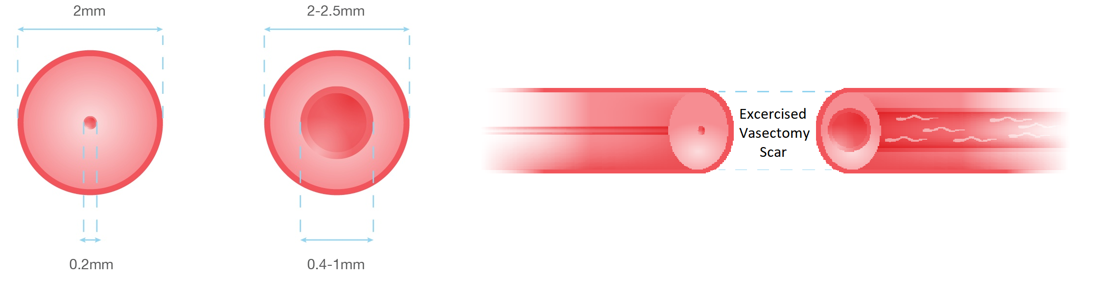 Multi-layer Microdot Vasovasostomy Step 2