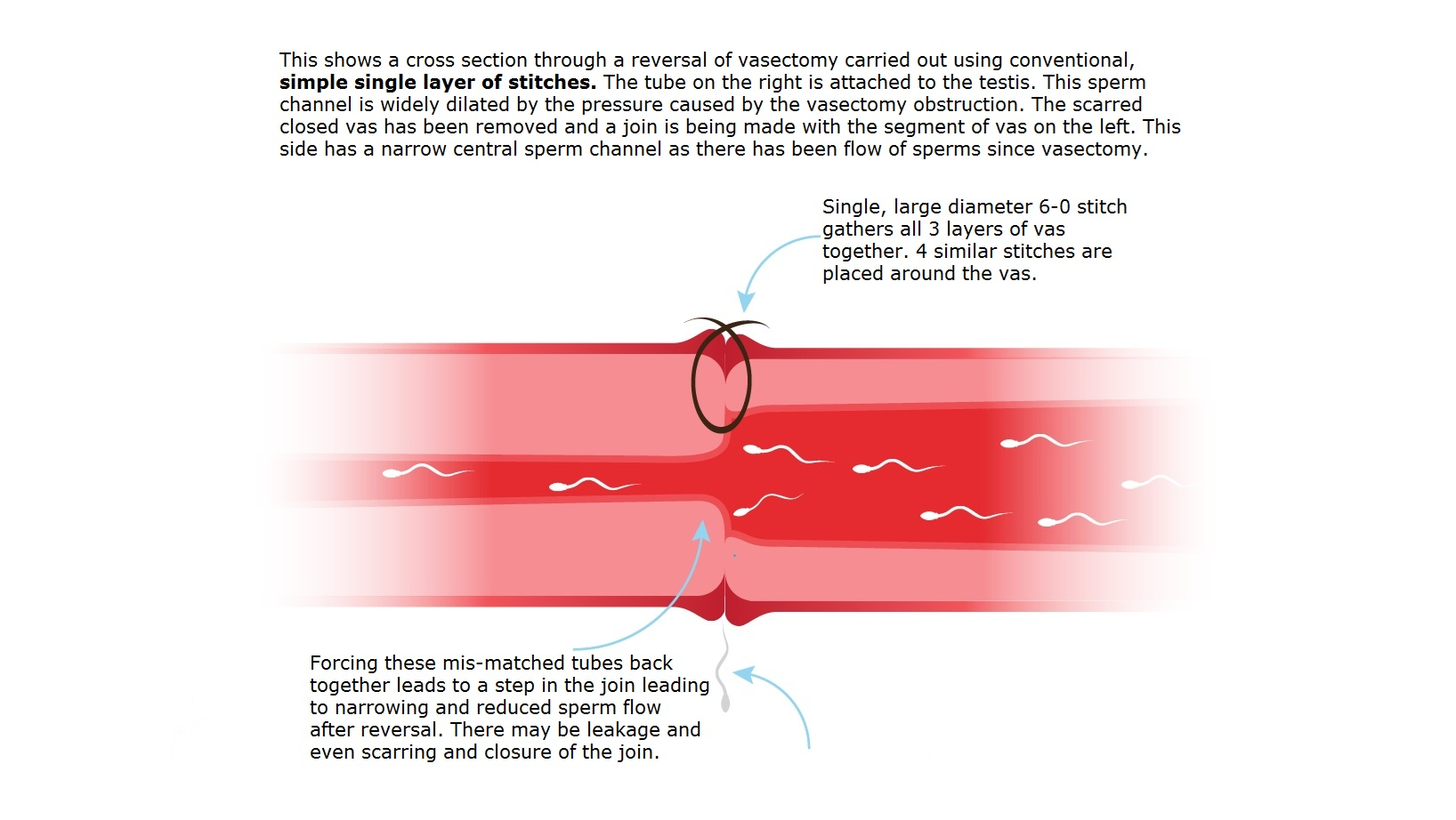 Multi-layer Microdot Vasovasostomy Step 4