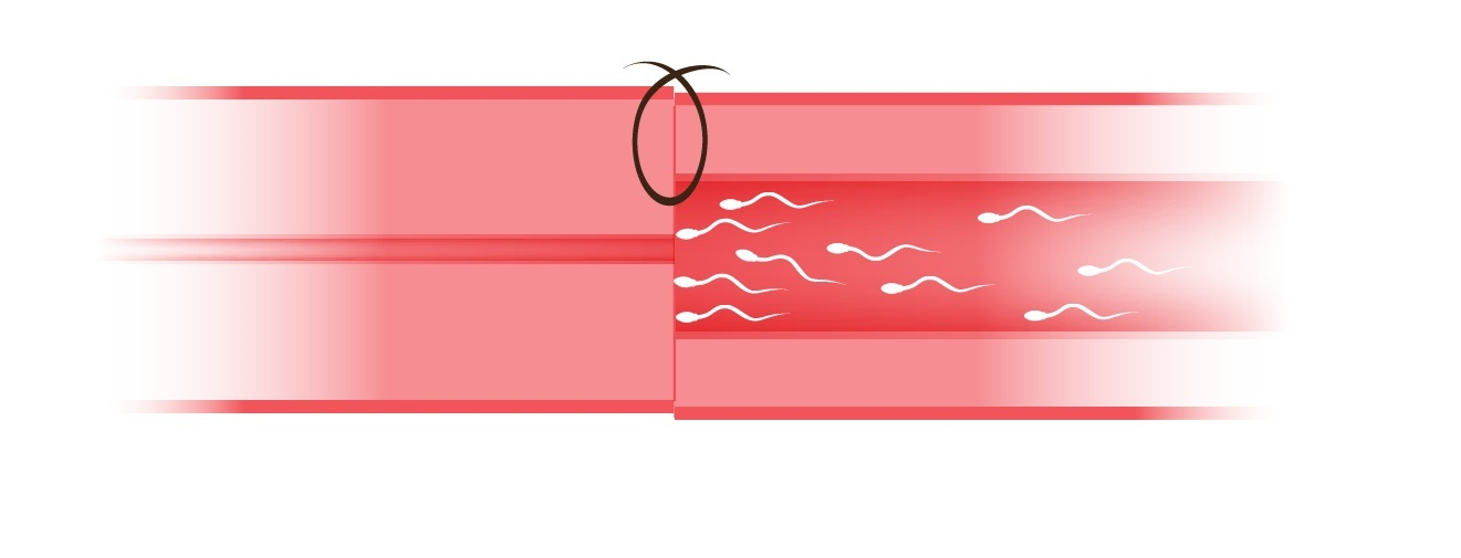 Multi-layer Microdot Vasovasostomy Step 3