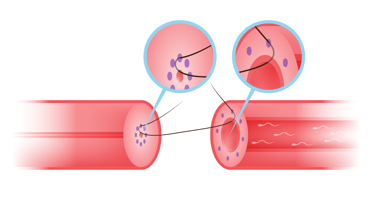 Multi-layer Microdot Vasovasostomy Step 5