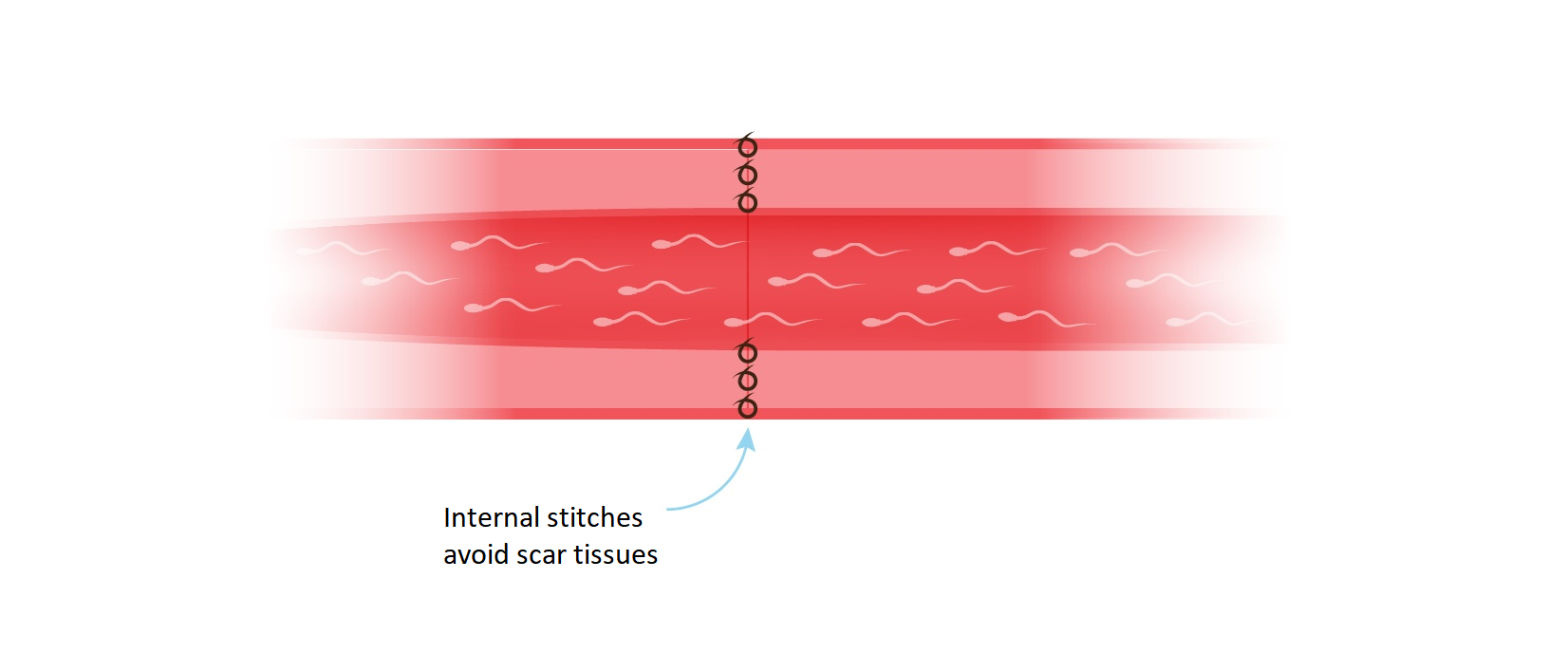 Multi-layer Microdot Vasovasostomy Step 7